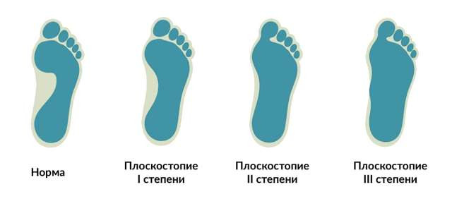 Как выглядит стопа здорового человека