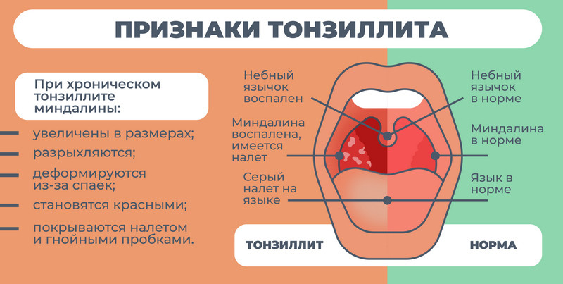 Промывание миндалин | Добромед