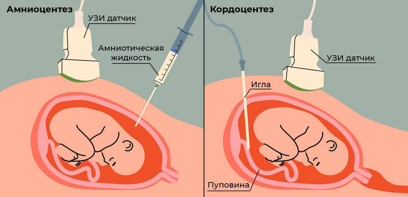 Гельминты и беременность
