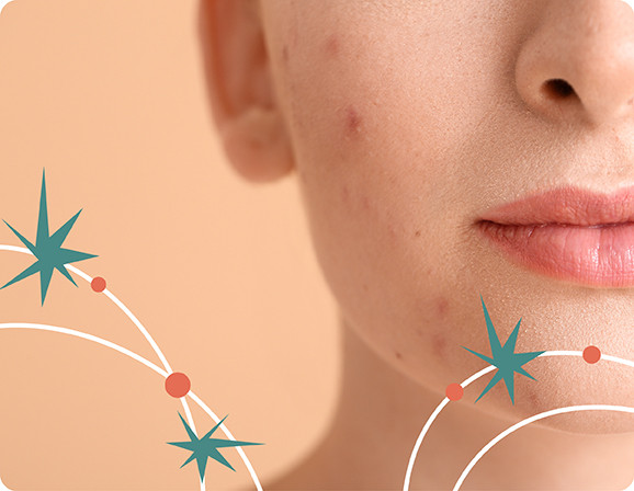 Постакне: что делать, когда прыщи прошли, а следы остались?